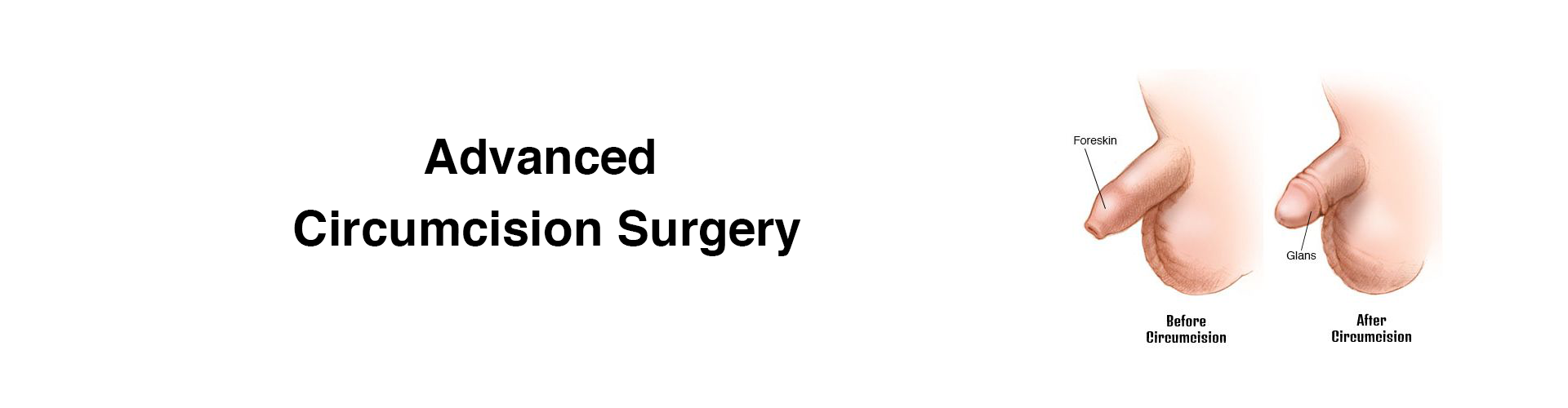 Circumcision surgery in chennai